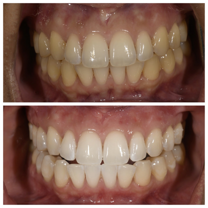 Shyné™ - Let your smile shine.